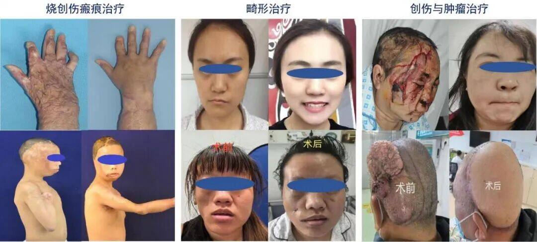 解放军总医院第四医学中心烧伤整形医学部：救生命于水火卫勤先锋谱忠诚；抚伤痕于无形大医精诚塑新生